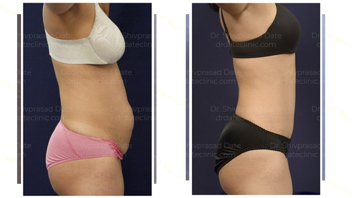 Best Liposuction Treatment in Mumbai